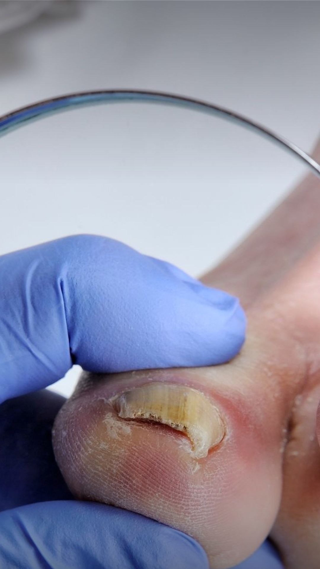 TRATAMIENTO DE HONGOS Y UÑAS