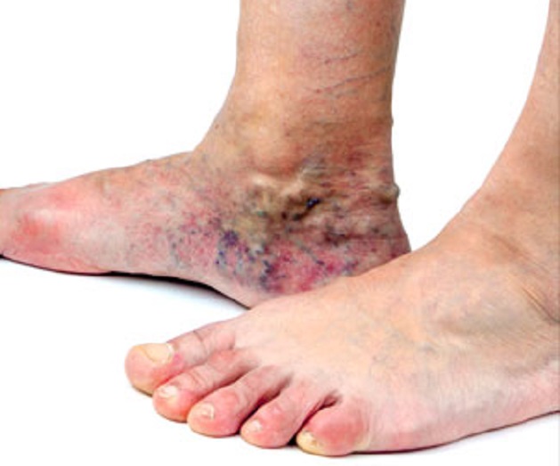 TRATAMIENTO PIES ADULTO MAYOR